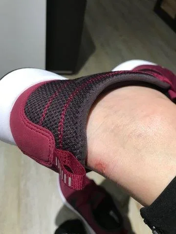 Heel abrasion from the Nike Dualtone Racer's heel tab